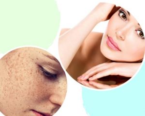 Điều trị tàn nhang