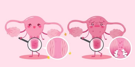 Viêm âm đạo và âm đạo bình thường Viêm âm đạo và âm đạo bình thường